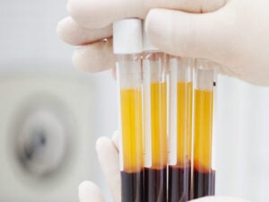 COVID-19: Beneficios y deficiencias de la terapia de plasma convaleciente